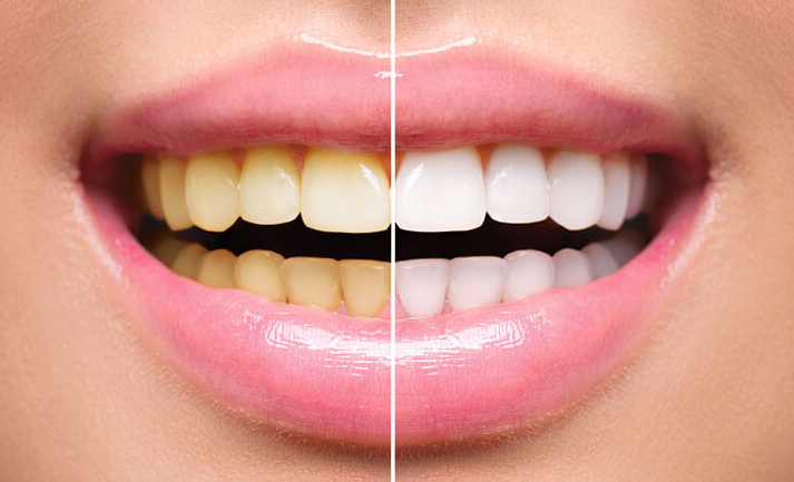 teeth whitening treatment in Dubai