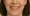 Can a Misaligned jaw be fixed with Braces
